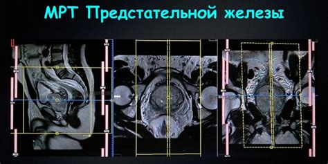 Важность исследования тканей предстательной железы