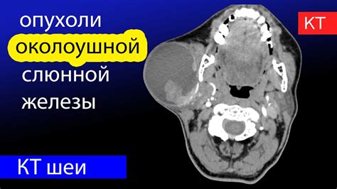 Важность парасимпатических волокон для нормальной работы околоушной слюнной железы