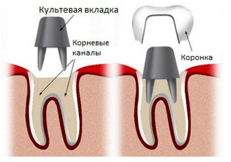 Виды арматуры для зубной коронки