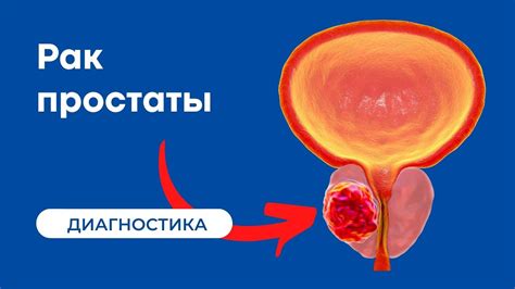 Влияние рака предстательной железы на температуру тела