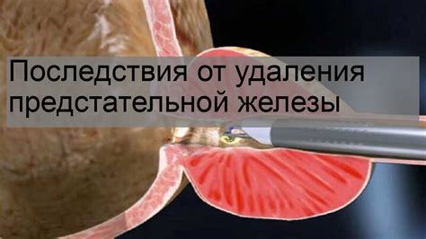 Влияние удаления предстательной железы на организм