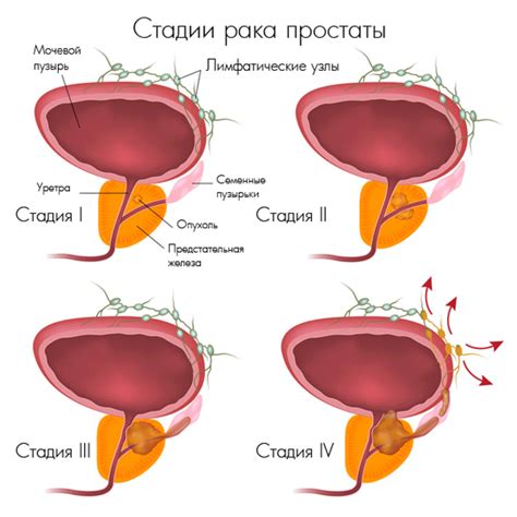 Внешняя пальпация предстательной железы: ключевые способы