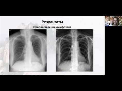 Возможности использования модификаций грудной полости