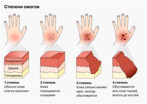 Возможные ожоги при работе