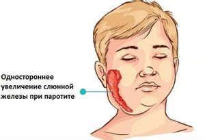 Возможные осложнения воспаления слюнной железы