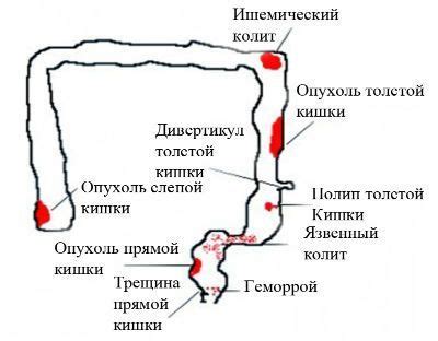 Возможные причины запаха металла в кале