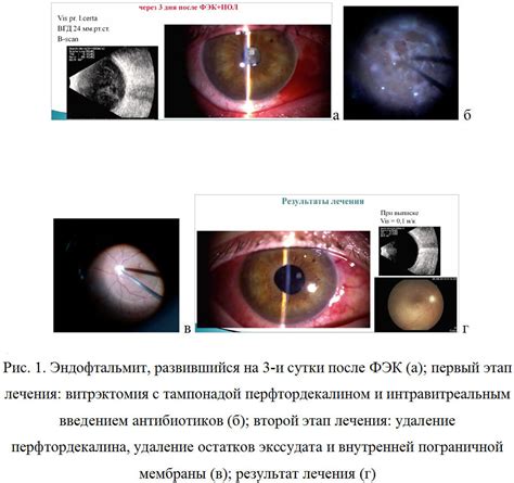 Второй этап разборки кинескопа: удаление стеклянной оболочки