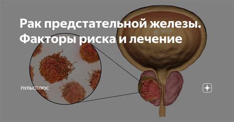 Выбор между консервативным и оперативным лечением проблем предстательной железы: факторы, влияющие на решение