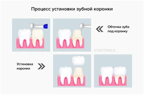 Высокая надежность и долговечность коронок