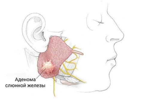 В рубриках "Киста на слюнной железе": причины, симптомы и лечение