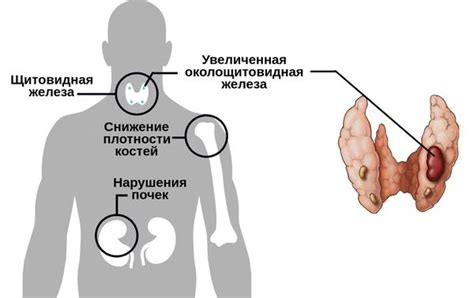 Гиперпаратиреоз: симптомы, диагностика, лечение