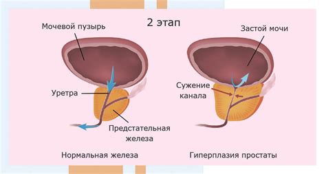 Гиперплазия предстательной железы: симптомы и особенности лечения