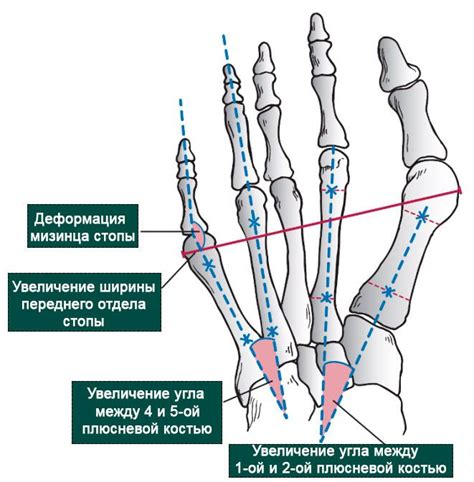 Деформация и искривление элементов