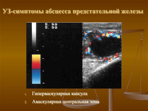 Диагностика абсцесса предстательной железы