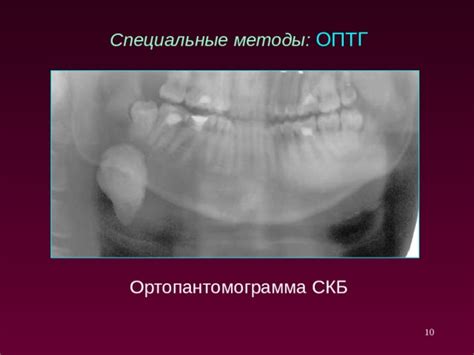 Диагностика гипоэхогенного образования на слюнной железе