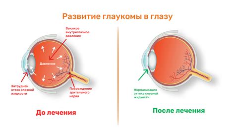 Диагностика и лечение глаукомы в клинике глазной хирургии