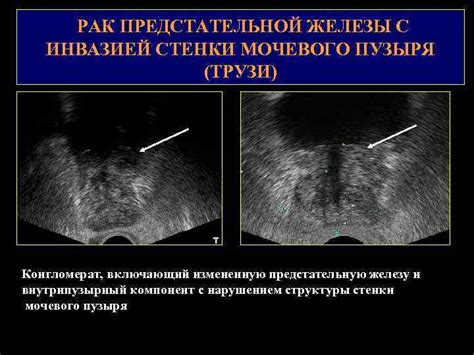 Диагностика надавливания на предстательную железу