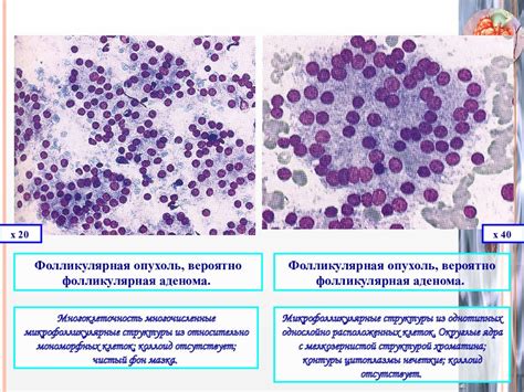 Диагностика опухолей и опухолеподобных образований на паращитовидной железе