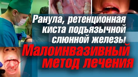 Диагностика ретенционной кисты слюнной железы