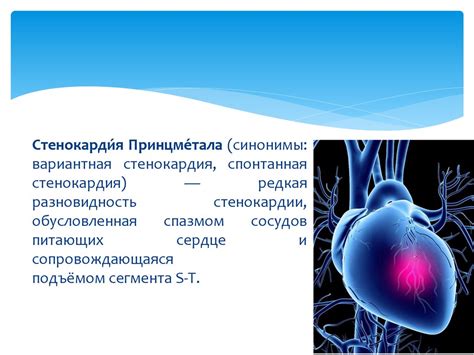 Диагностика стенокардии принца металла