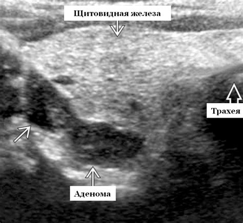 Злокачественные опухоли паращитовидной железы