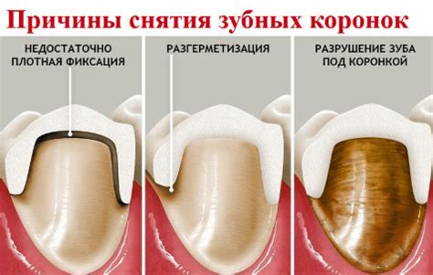 Значение арматуры для зубной коронки