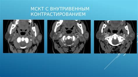 Изменения в работе слюнных желез после удаления опухоли