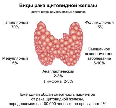 Какие методы лечения кисты на паращитовидной железе существуют?