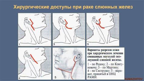 Какие последствия могут возникнуть после удаления слюнной железы?