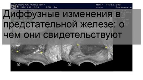 Какие симптомы могут свидетельствовать о наличии кальцинатов в предстательной железе?