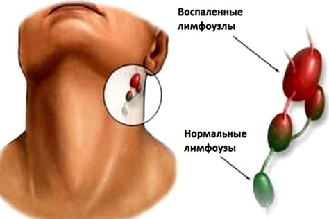 Какие симптомы сопровождают воспаление железы на шее?