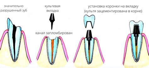 Как выбрать и купить металлическую коронку онлайн