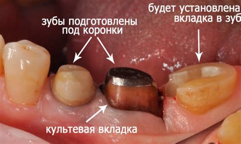 Как выбрать металл для своей культевой вкладки?