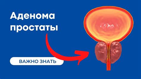 Как проводится диагностика и определение кальцинатов предстательной железы?