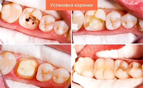 Как устанавливается арматура на зубную коронку?