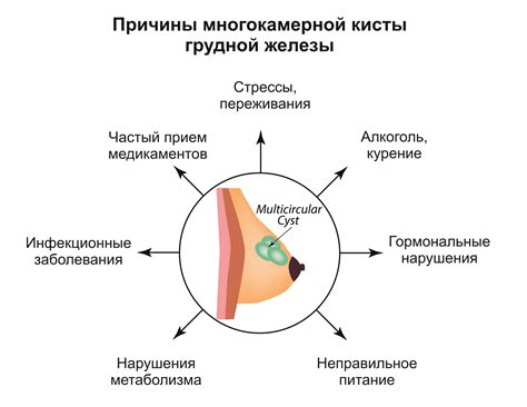 Киста молочной железы