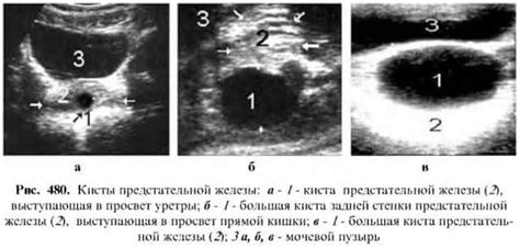 Киста на предстательной железе: важно знать