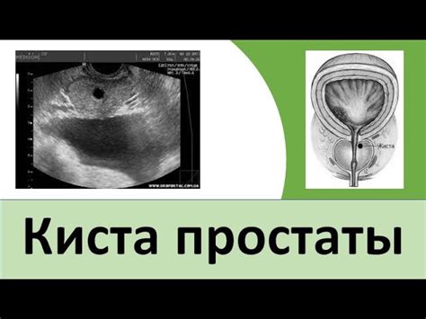 Киста на предстательной железе у мужчин