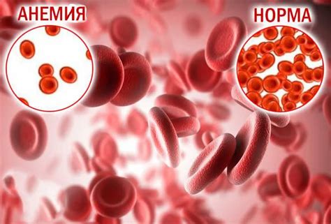 Лечение анемии при нормальном уровне железа