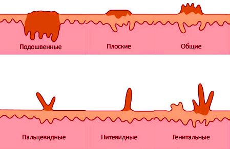 Лечение папилломы груди