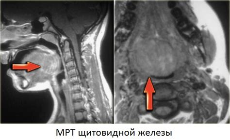 МРТ и КТ щитовидной железы