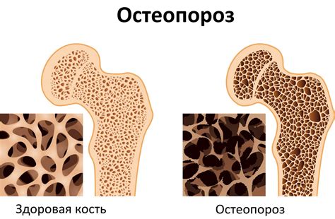 Медь и остеопороз