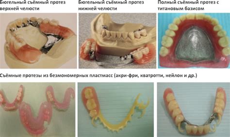 Металлы, используемые в производстве протезов