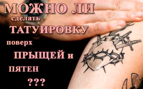 Можно ли сделать татуировку с аллергией на металл?