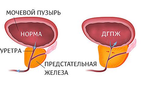 Неправильное половое поведение и инфекции: риск для предстательной железы