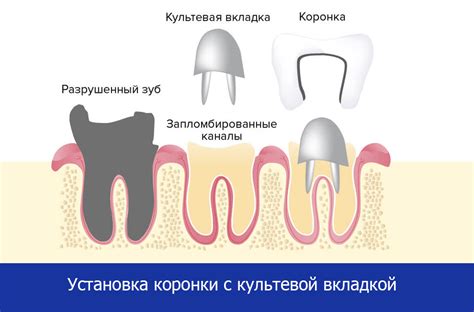 Области применения культевой вкладки