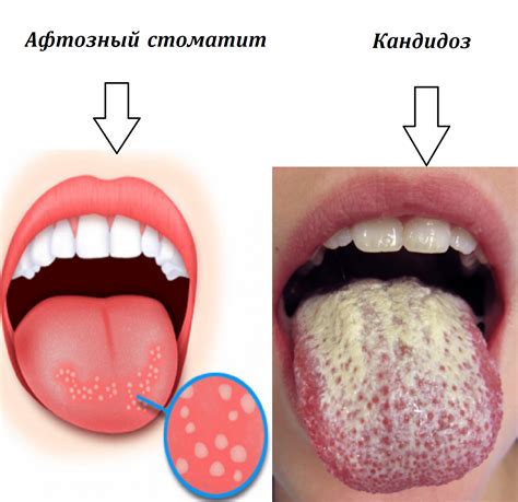 Окисленные металлы внутри рта и на языке