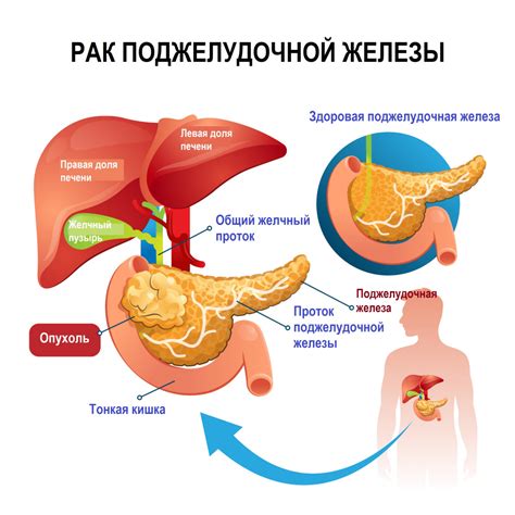 Операция на подъязычную слюнную железу: симптомы, причины и последствия