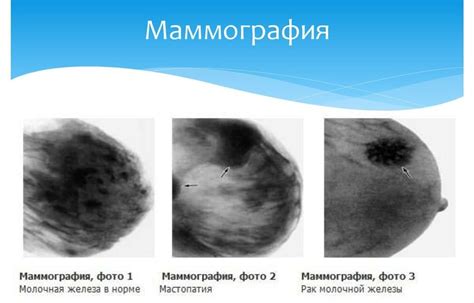 Описание процедуры маммографии