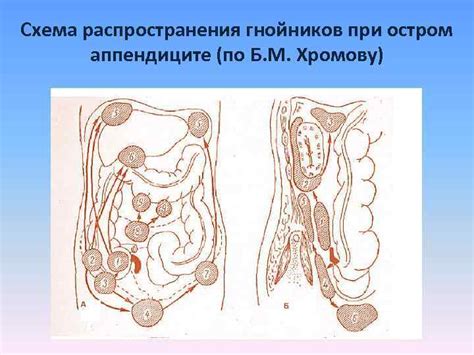 Осложнения при запущенном аппендиците